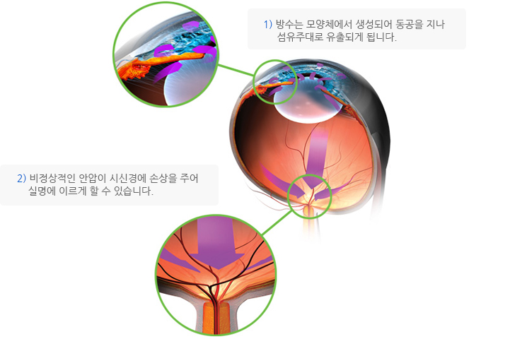 녹내장이란