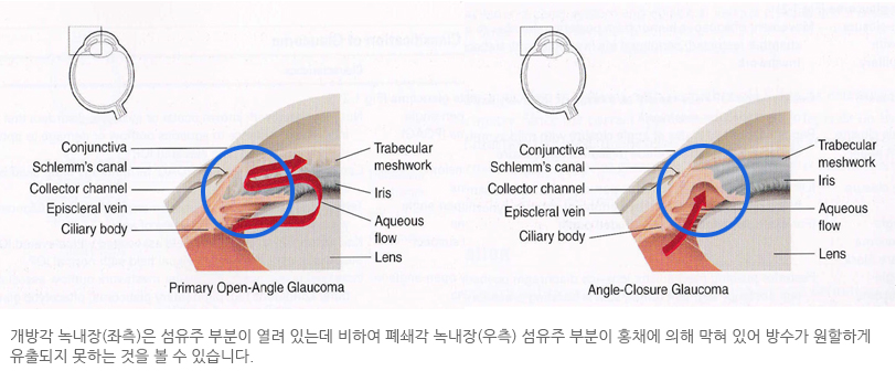 개방각, 폐쇄각